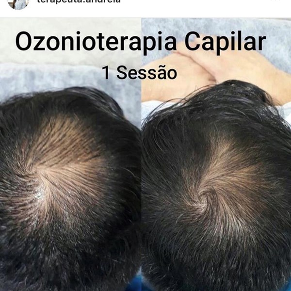 Ozonioterapia no SUS: Onde Encontrar e Como Acessar o Tratamento Capilar