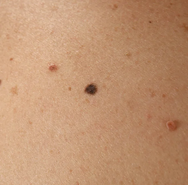 Guia Completo da Regra do ABCDE para Autoexame de Pintas