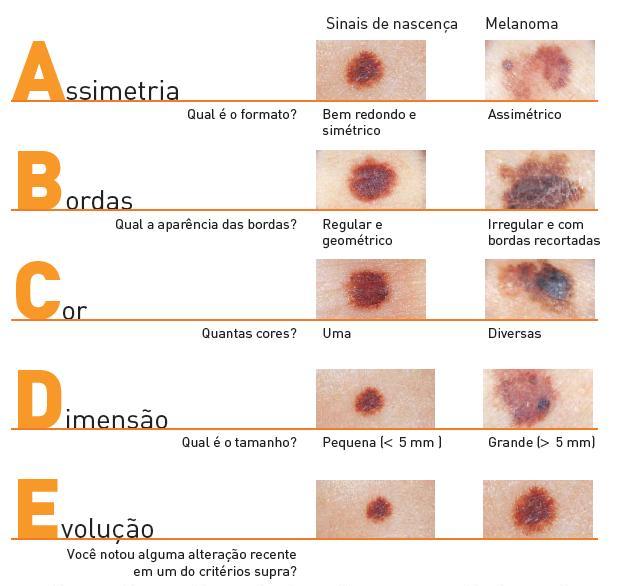 Pintas Benignas vs. Melanoma: Saiba as Diferenças Cruciais