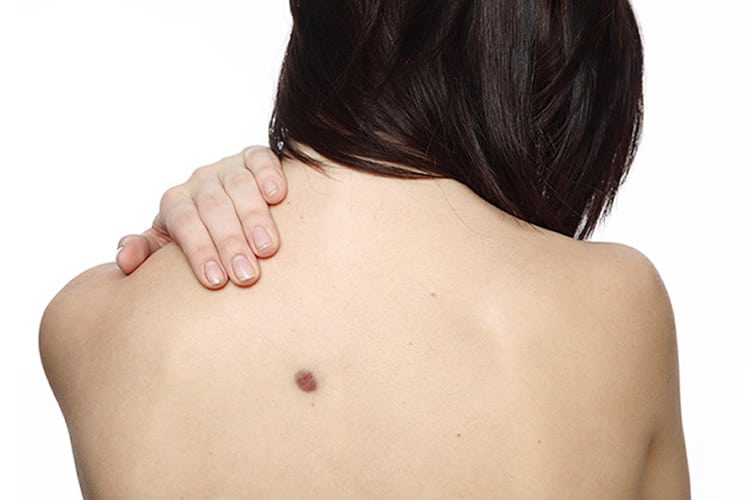 Sinais de Alerta: Quando uma Pinta na Palma da Mão é Preocupante?