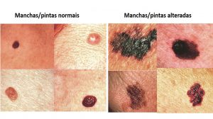 Além do Câncer: Outras Causas de Manchas Escuras na Pele