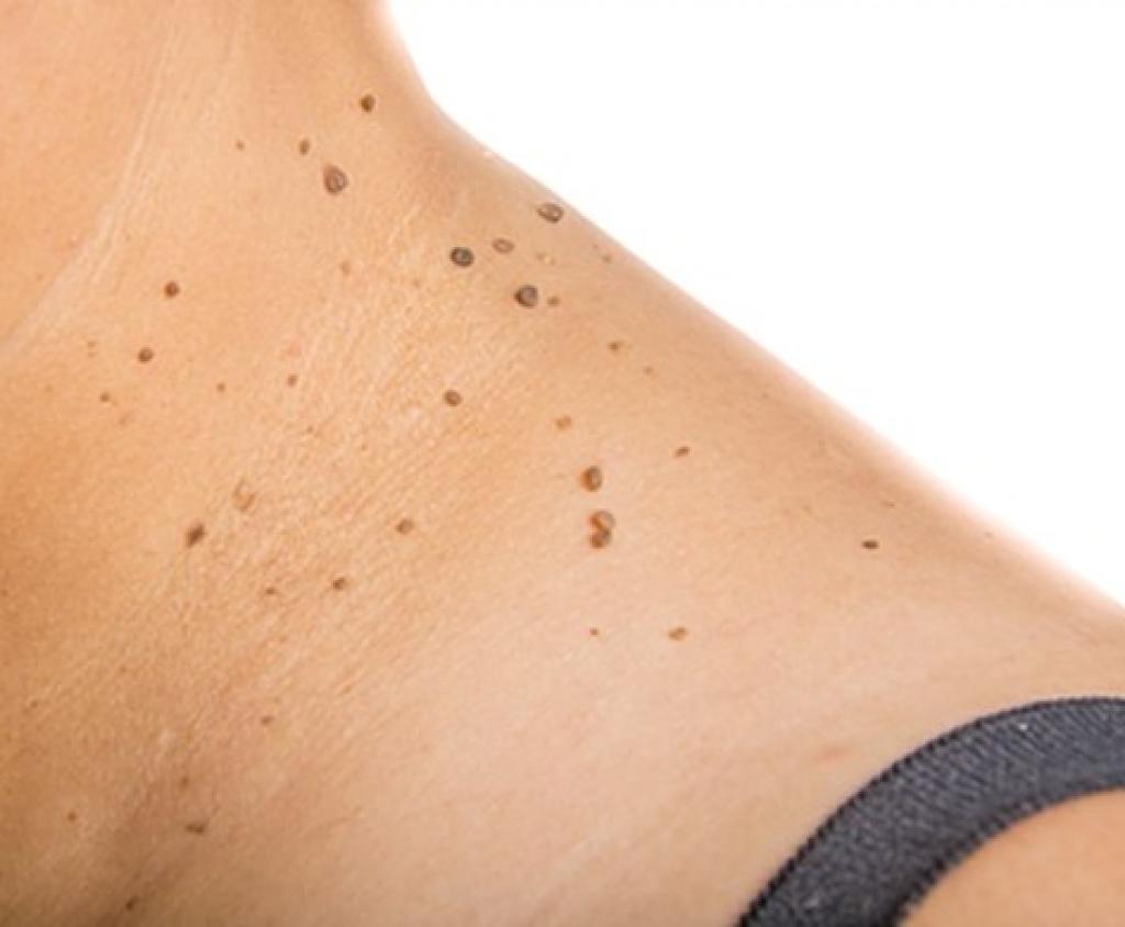 Dermatoscopia: O Exame Essencial para o Diagnóstico de Lesões de Pele