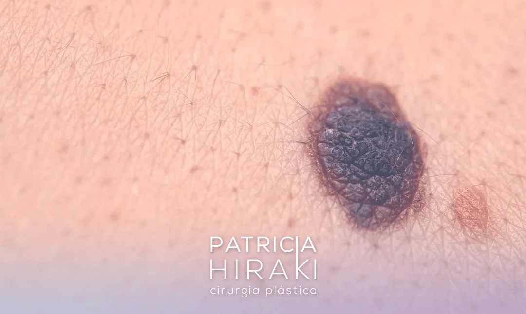 Sinais Pretos Na Pele