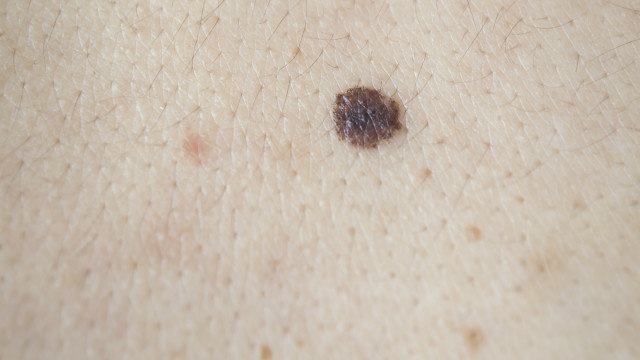 Pintas Benignas vs. Melanoma: Saiba as Diferenças Cruciais