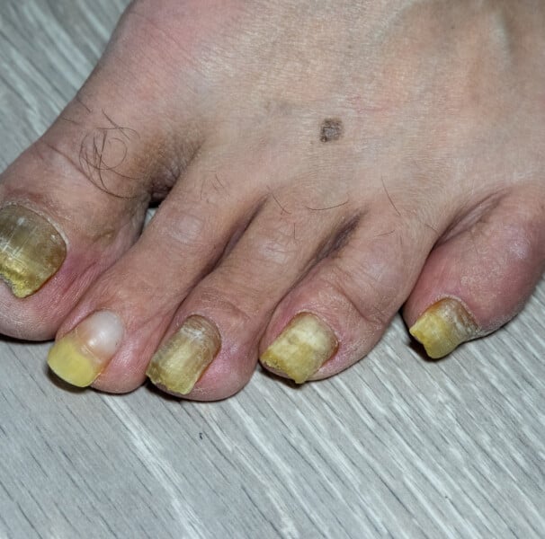 como cuidar da síndrome da unha amarela dicas essenciais