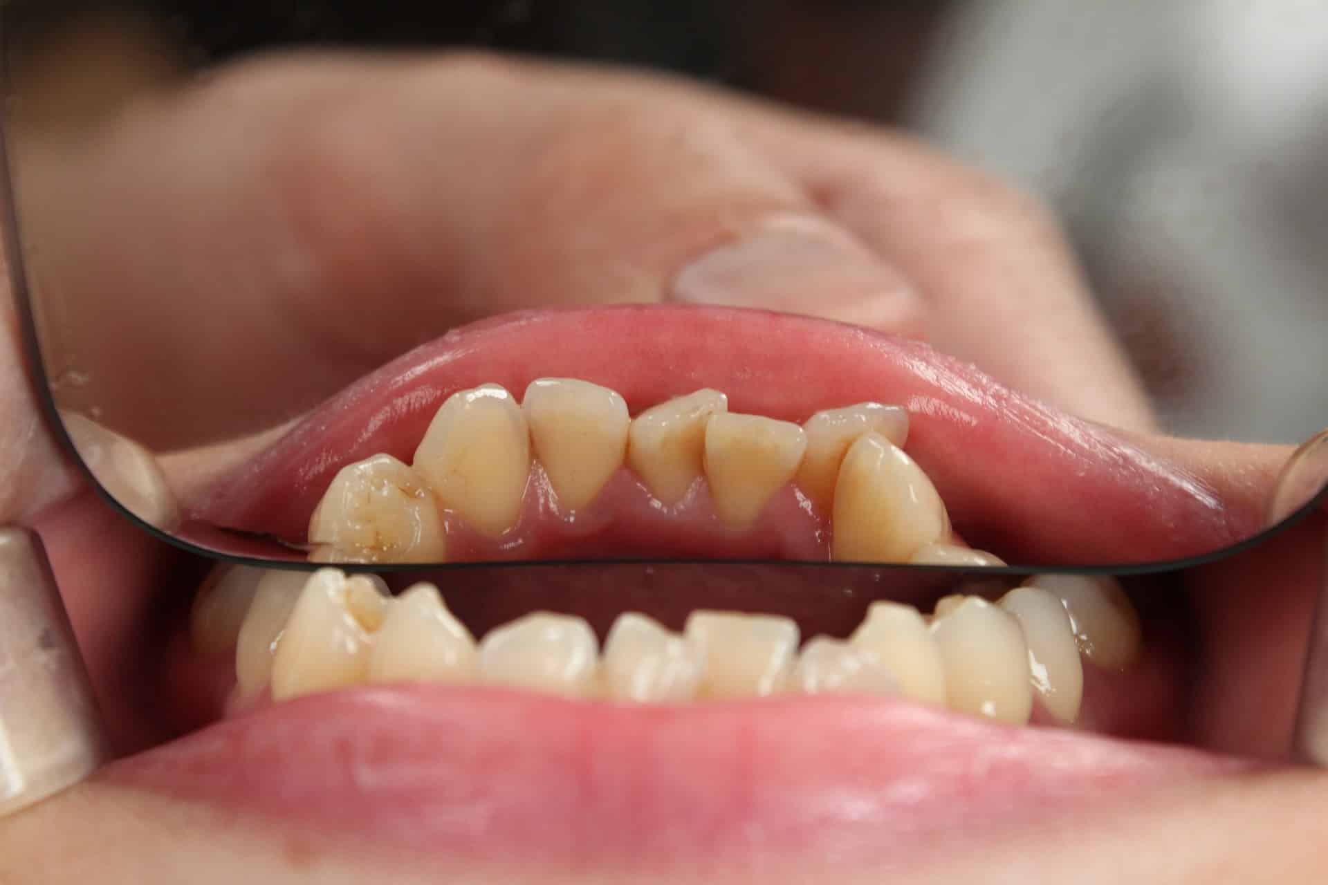 Como a Insegurança Afeta Seus Sonhos: O Caso dos Dentes Tortos