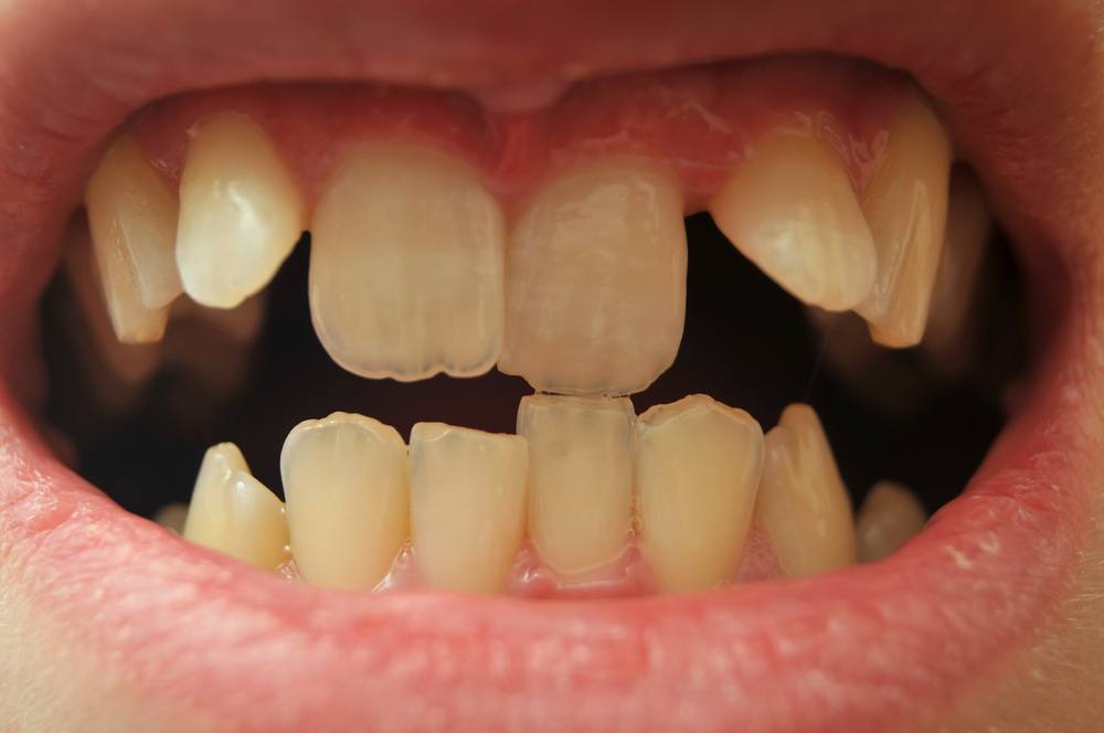 Desvendando o Significado de Sonhos com Dentes: Guia Completo