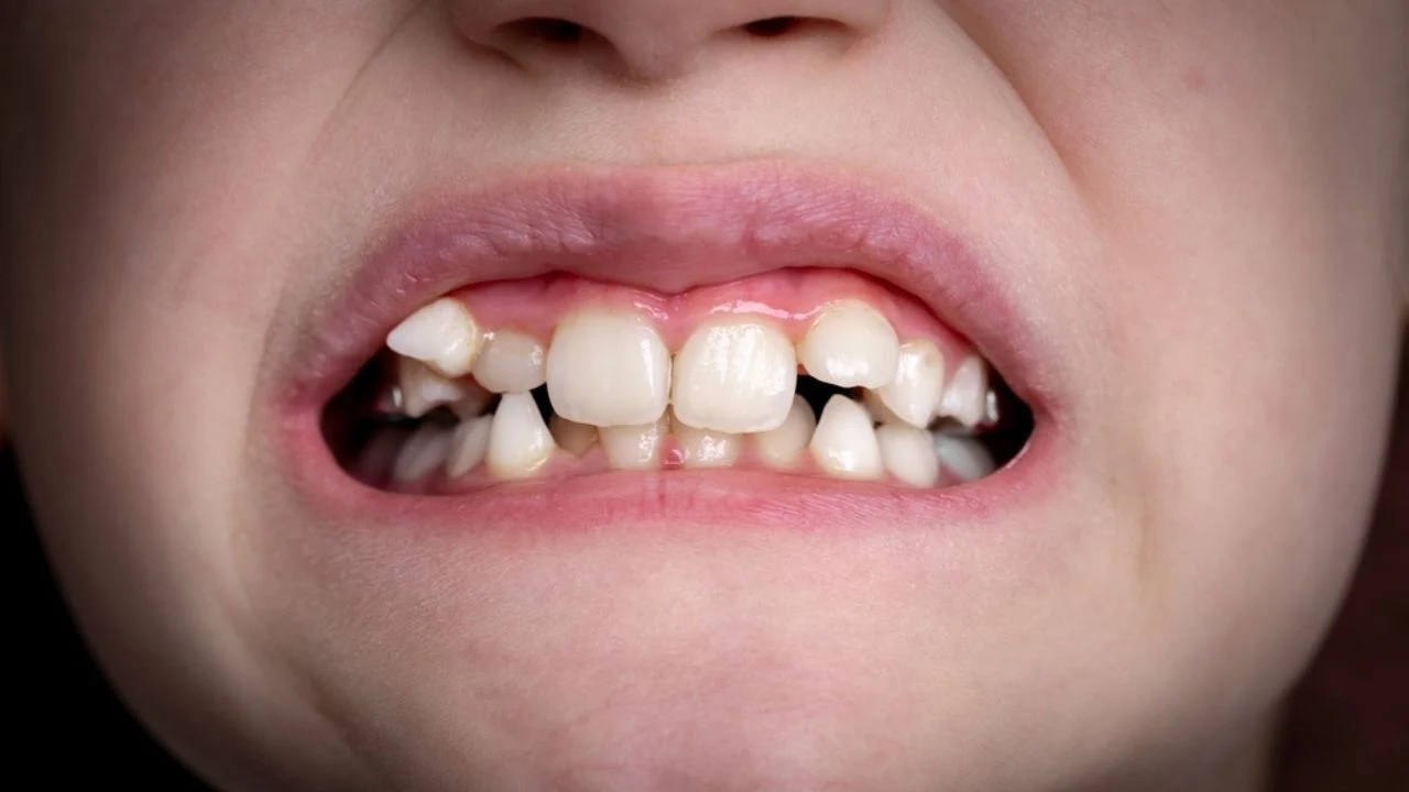 Sonhar Com Dentes Tortos