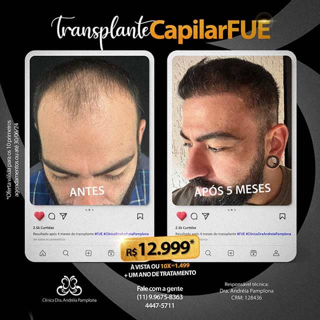 Guia Completo de Suplementos Pós-Transplante Capilar