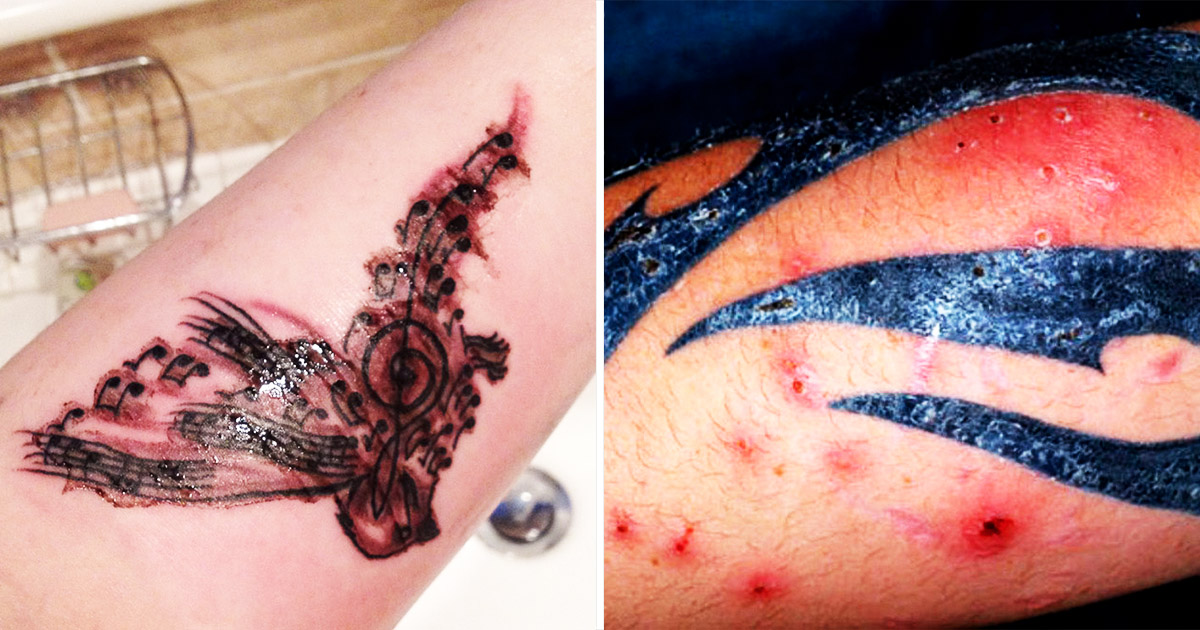 fotos de tatuagem inflamada e como tratar