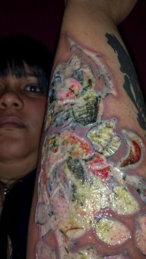 como aliviar inchaço de tatuagem inflamada rapidamente