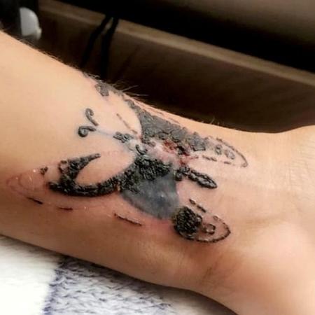 fotos de tatuagem inflamada e como tratar