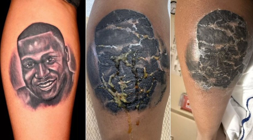 erros comuns ao cuidar de tatuagem inflamada