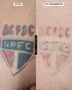 reação tinta vermelha tatuagem