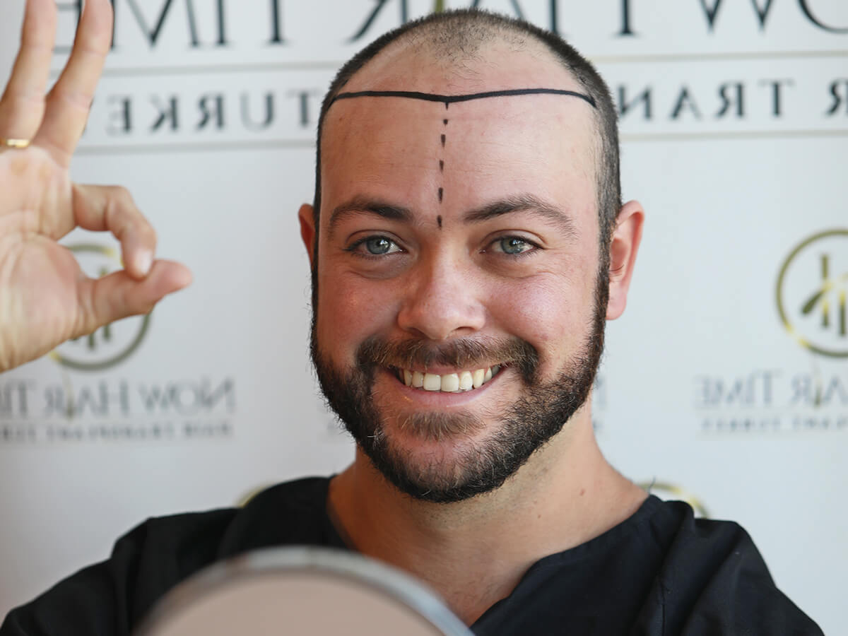 Resultados da Terapia Capilar com Células-Tronco: O Que Esperar?