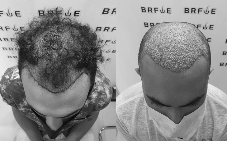 Terapia com Células-Tronco vs. Transplante Capilar: Qual a Melhor Opção?