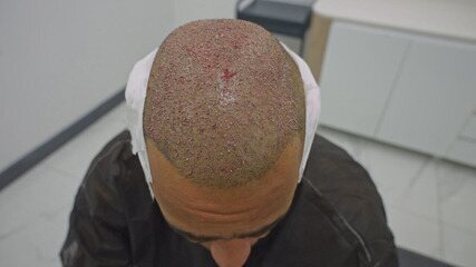 Tradutor para transplante capilar na Turquia