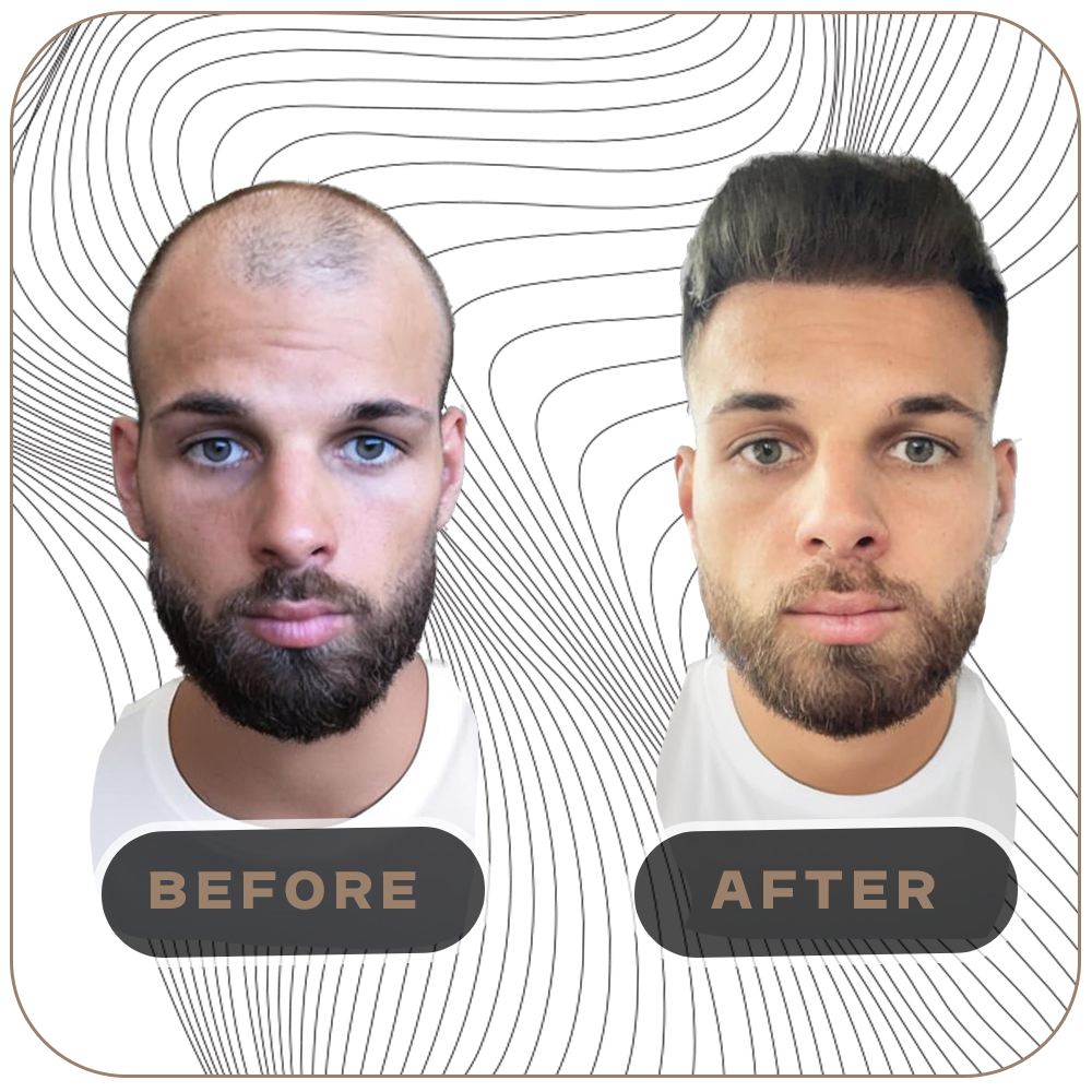 FUE vs. DHI vs. Sapphire FUE: Qual a Melhor Técnica de Transplante Capilar para Você?