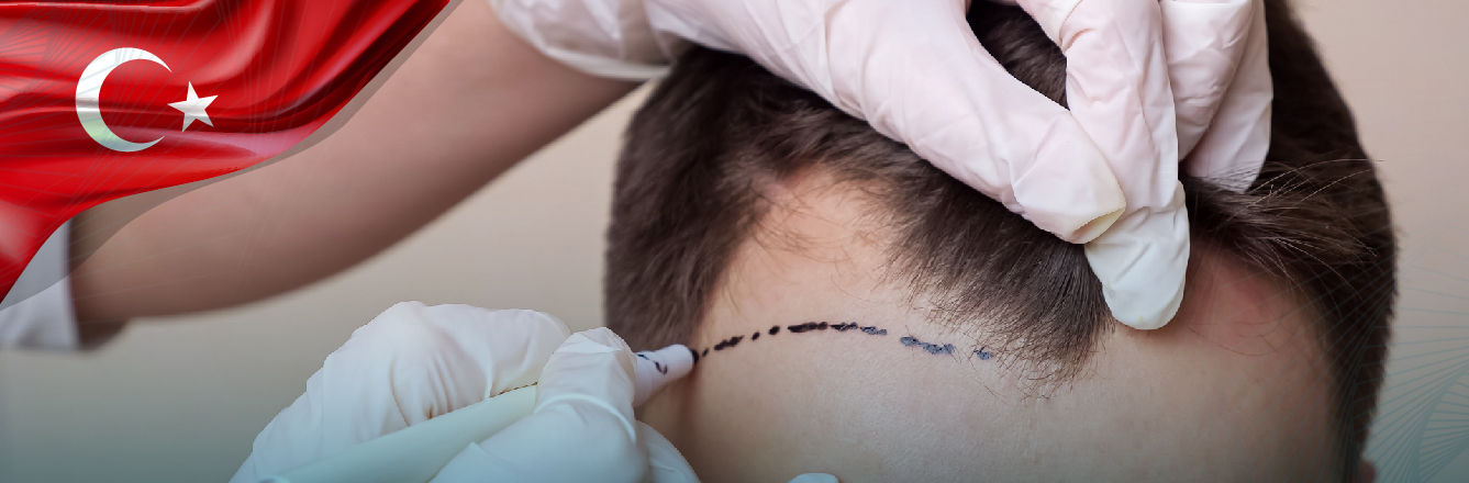 Depoimentos Reais: Experiências de Brasileiros com Transplante Capilar em Istambul