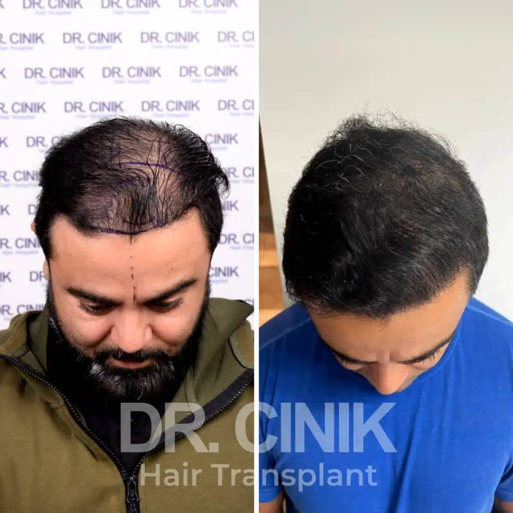 Tradutor para transplante capilar na Turquia