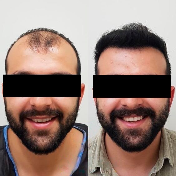 Transplante capilar em Campinas valores