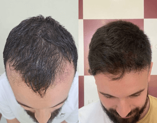 Pós-Operatório do Transplante Capilar: Cuidados Essenciais e Tratamentos Complementares