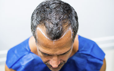 Resultados do Transplante Capilar: Expectativas e Realidade em Campinas