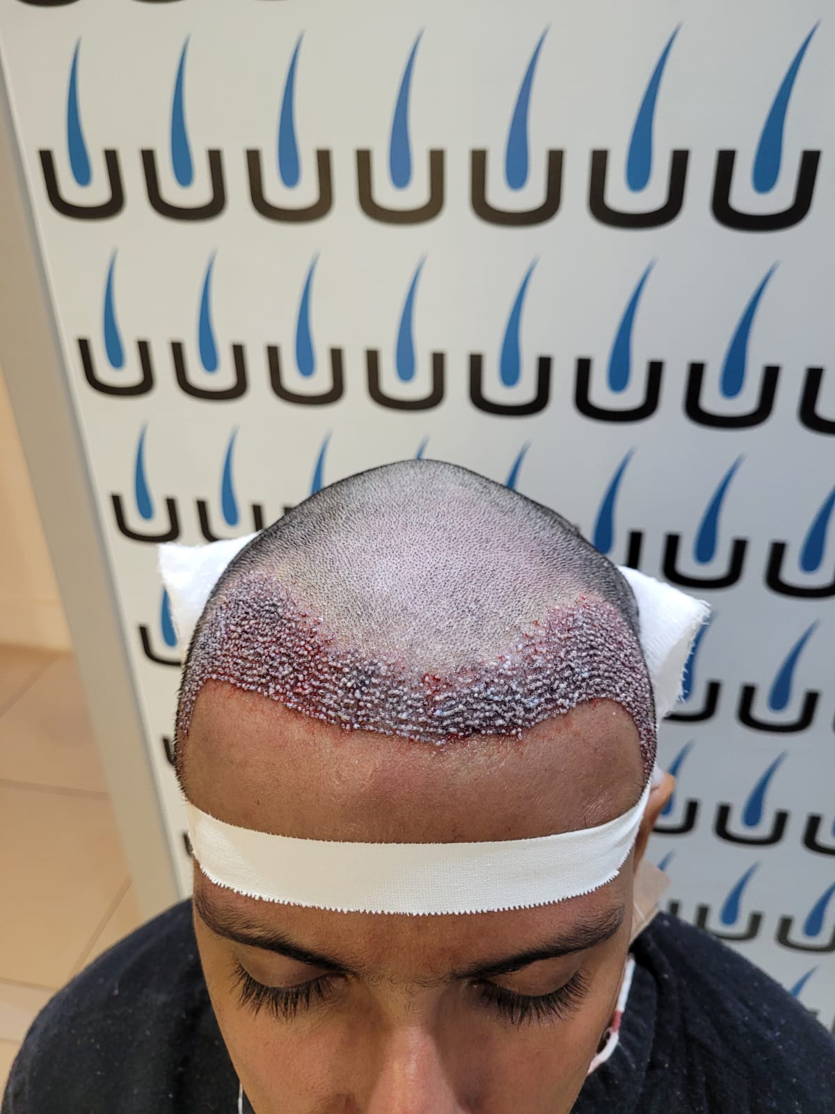 Como escolher a melhor clínica de transplante capilar em Foz do Iguaçu