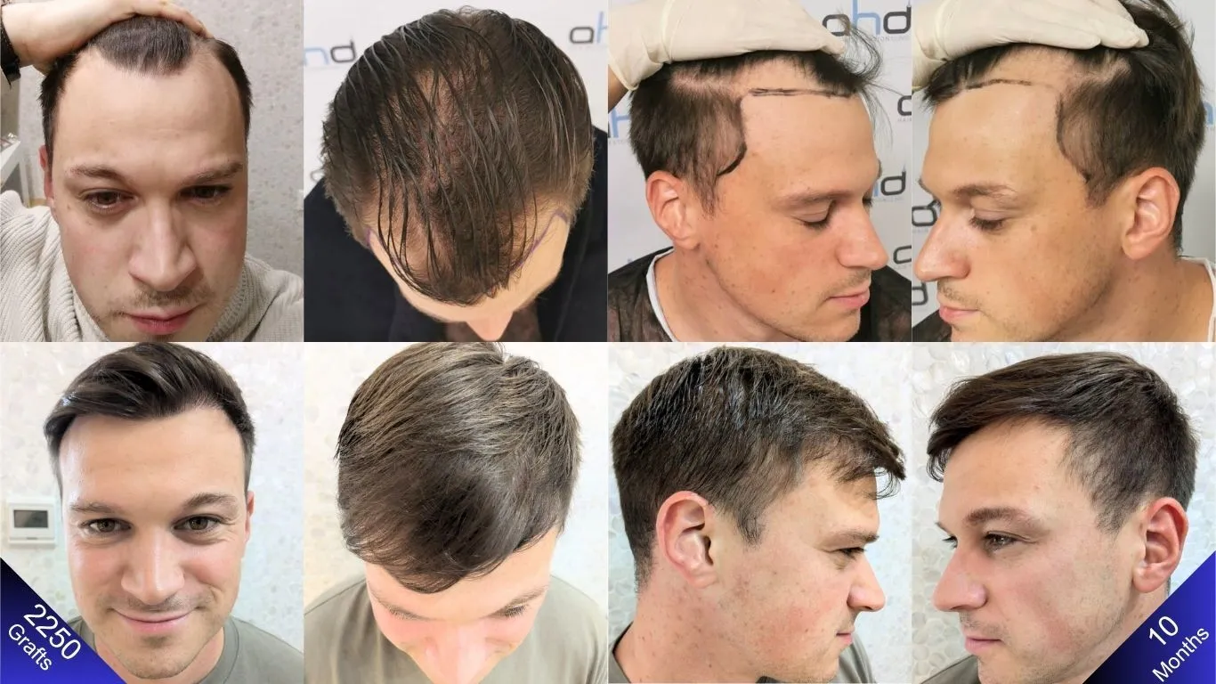 Transplante capilar FUE vs DHI: qual a diferença e o custo em Foz?