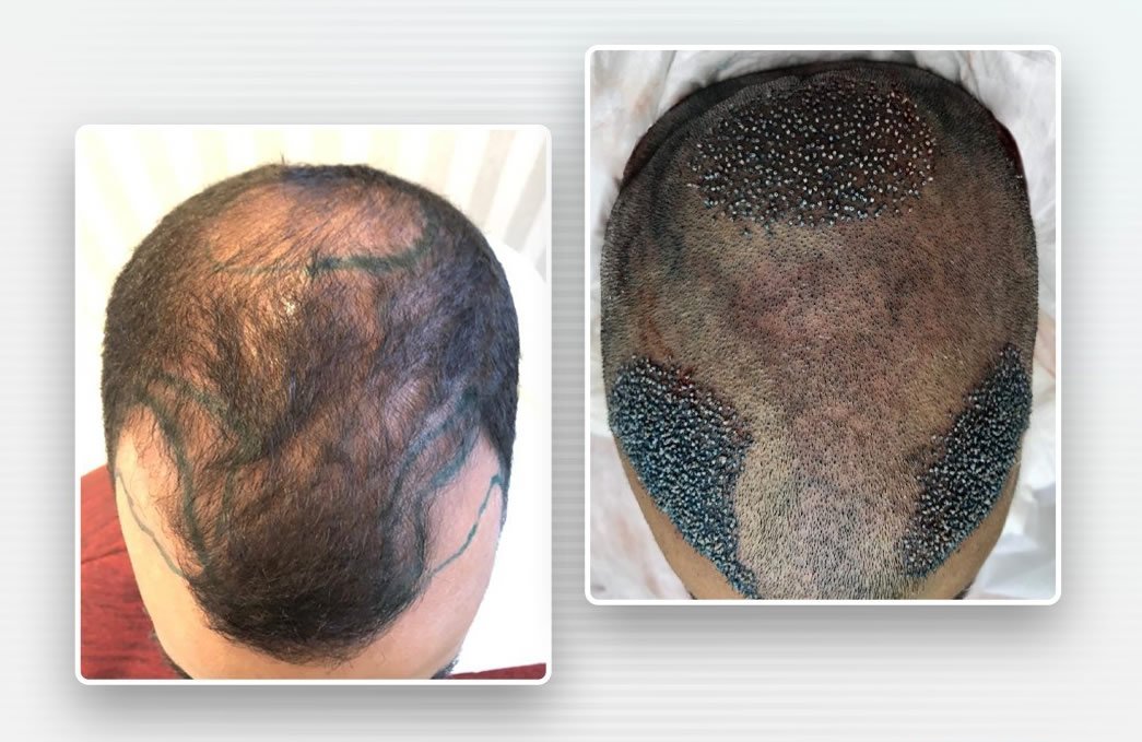 Transplante capilar com hospedagem inclusa em Foz: vale a pena?