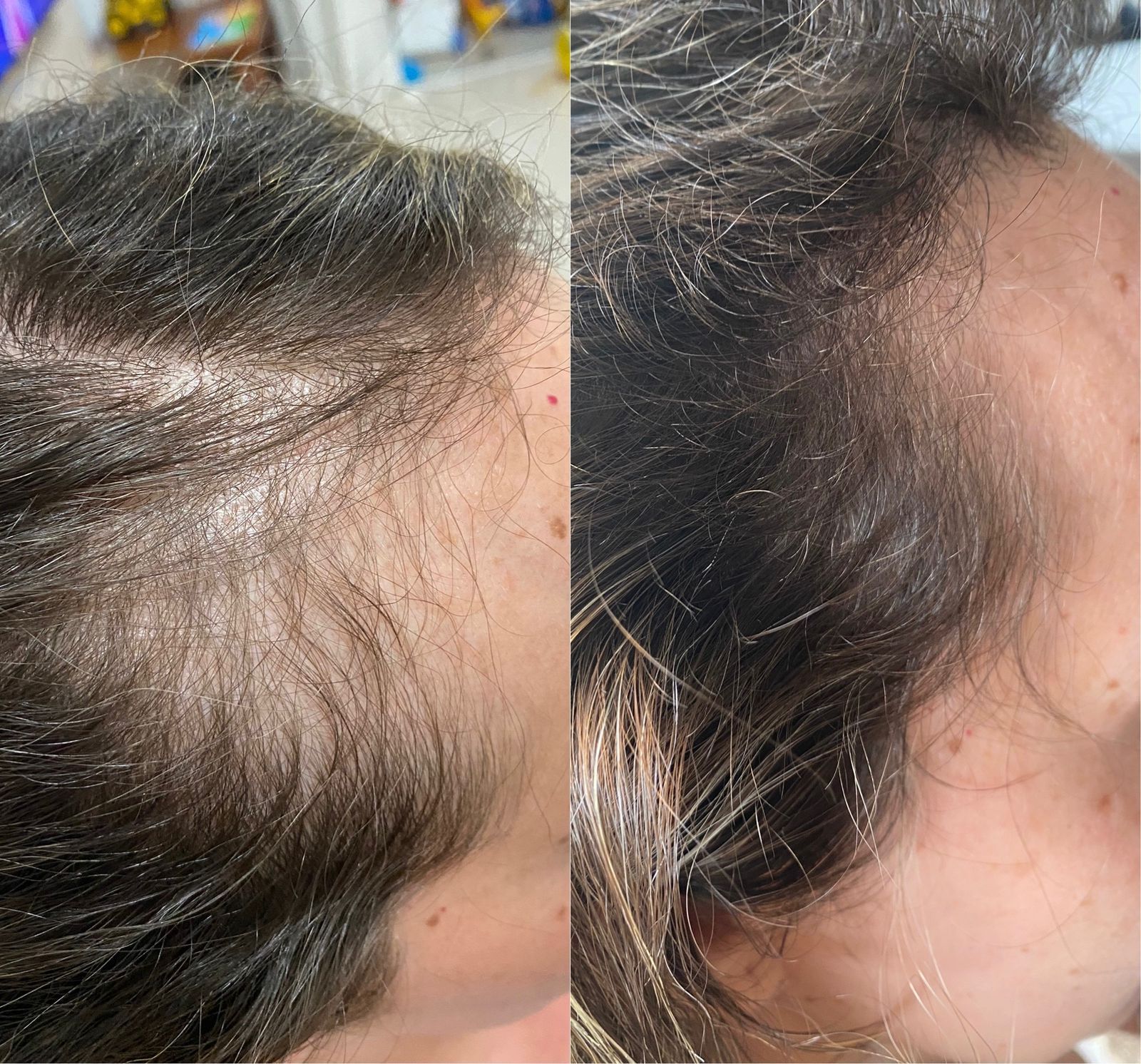 5 ideias de títulos:
1. Guia Completo: Tratamentos para Queda de Cabelo em Anápolis
2. Transplante Capilar em Anápolis: Opções e Especialistas
3. Tricologia Integrativa: A Nova Fronteira no Tratamento Capilar em Anápolis
4. Dermatologia Capilar em Anápolis: Diagnóstico e Soluções
5. Ozonioterapia Capilar: Benefícios e Onde Encontrar em Anápolis