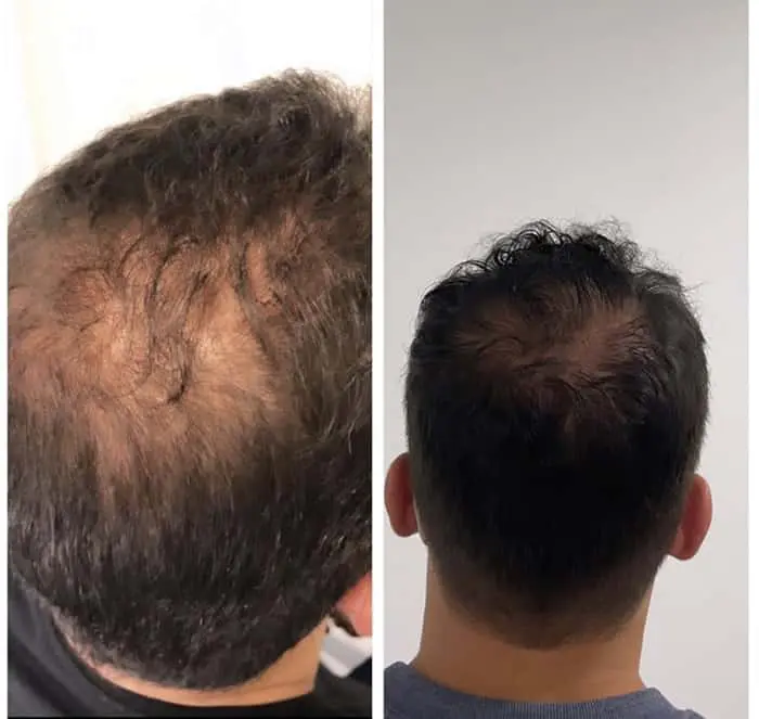 Tratamento de queda de cabelo em Nova Iguaçu