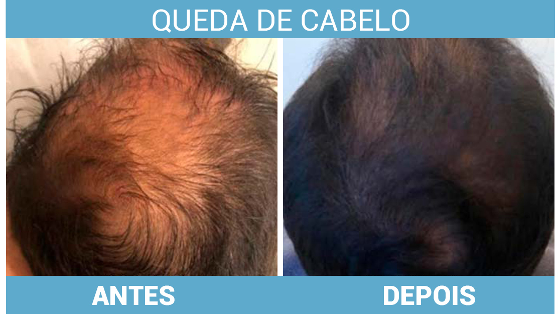 Tratamento de queda de cabelo em Nova Iguaçu