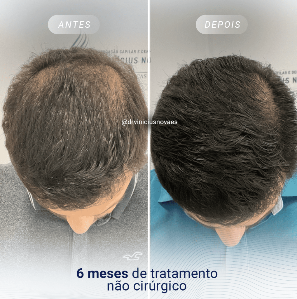 Dermatologistas em Nova Iguaçu para Queda de Cabelo: Opções e Abordagens