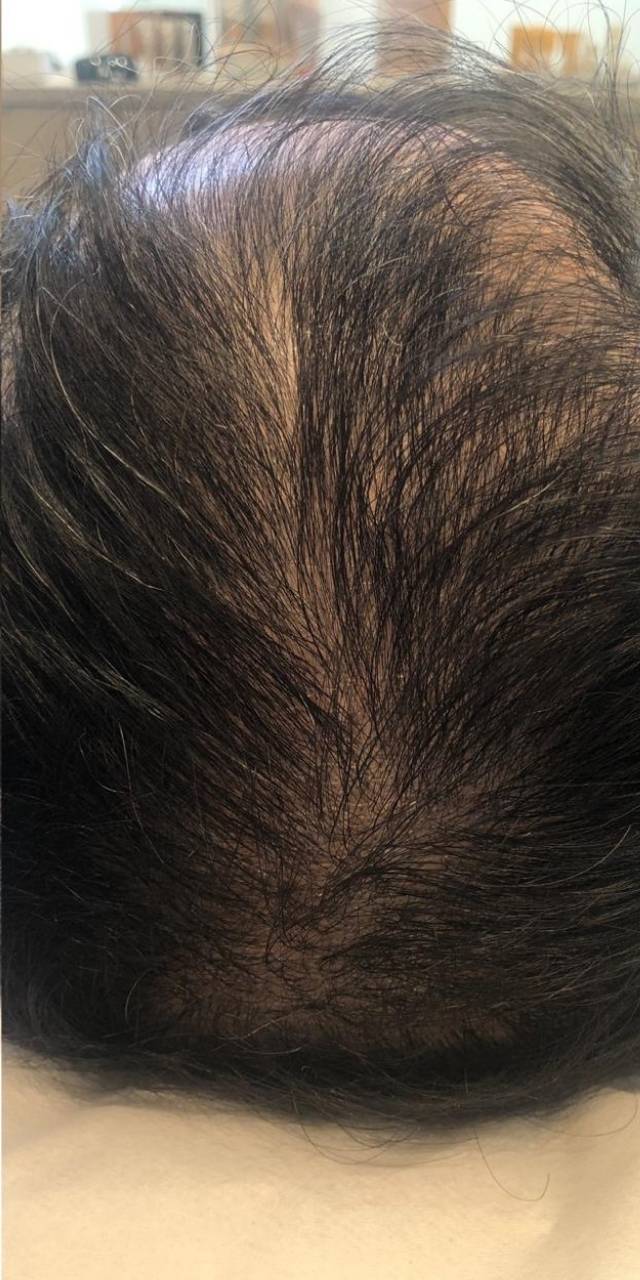 Tratamento de queda de cabelo em Olinda