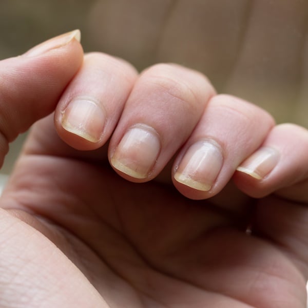 unha amarela micose ou esmalte como saber a diferença