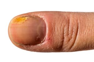 erros comuns que causam unha amarela e como evitar