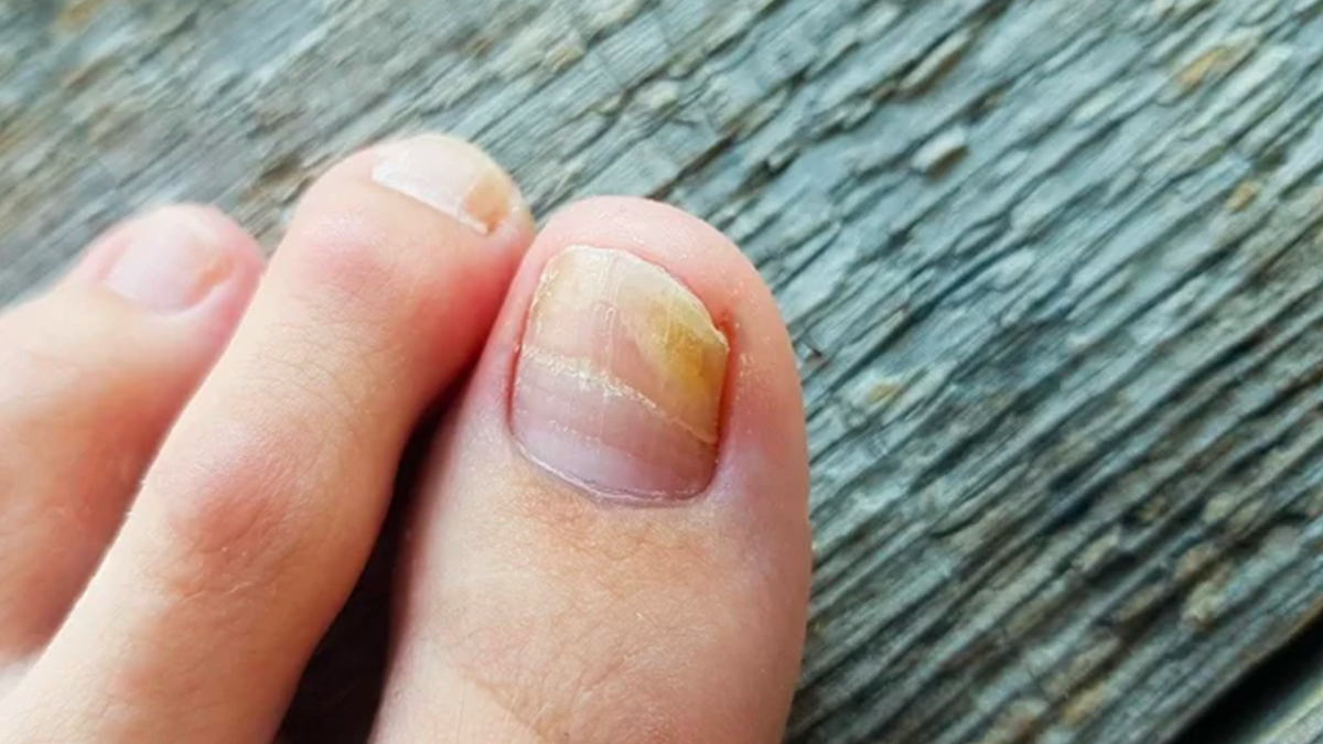 5 dicas essenciais para evitar unhas amarelas