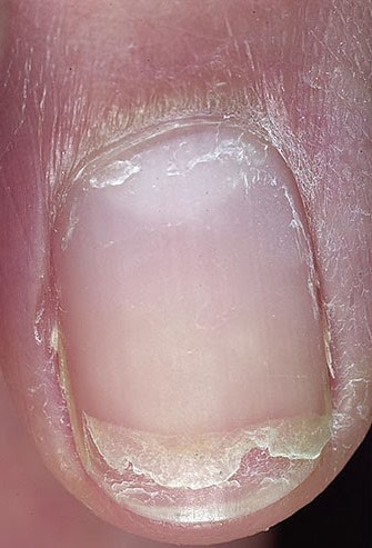 erros comuns ao cuidar de unhas descamando