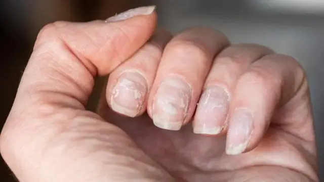 Quando Consultar um Dermatologista sobre Problemas nas Unhas
