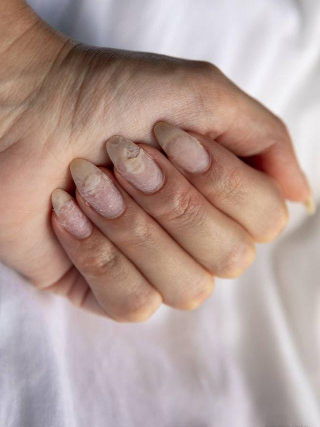 Como a Tireoide Afeta a Saúde das Suas Unhas