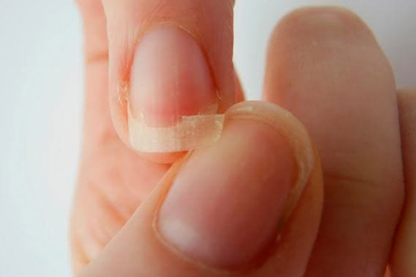 Unhas Descamando O Que Pode Ser