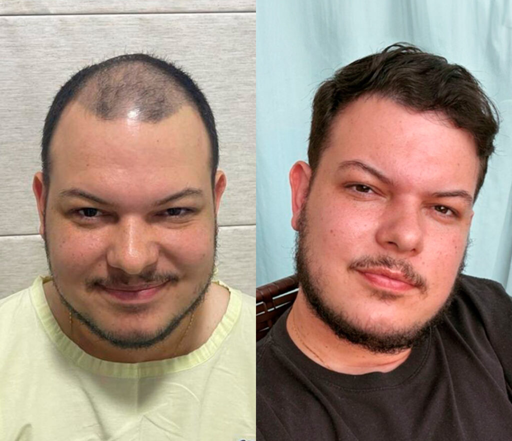 5 ideias de títulos:
1. Implante Capilar em Sinop: Guia Completo de Preços e Técnicas para 2026
2. FUE vs. FUT: Qual a Melhor Técnica de Transplante Capilar em Sinop?
3. Quanto Investir em um Transplante Capilar em Sinop? Fatores que Influenciam o Custo
4. Os Melhores Especialistas em Transplante Capilar em Sinop: Onde Encontrar?
5. Transplante Capilar Não é Coberto pelo SUS: Entenda as Opções em Sinop