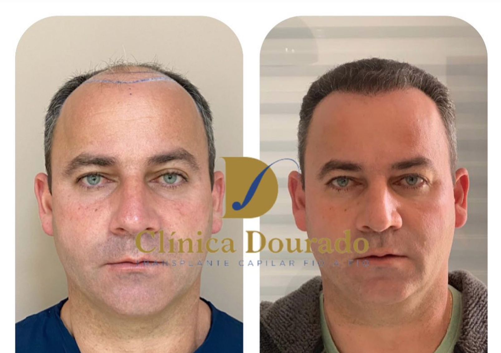 5 ideias de títulos:
1. Implante Capilar em Sinop: Guia Completo de Preços e Técnicas para 2026
2. FUE vs. FUT: Qual a Melhor Técnica de Transplante Capilar em Sinop?
3. Quanto Investir em um Transplante Capilar em Sinop? Fatores que Influenciam o Custo
4. Os Melhores Especialistas em Transplante Capilar em Sinop: Onde Encontrar?
5. Transplante Capilar Não é Coberto pelo SUS: Entenda as Opções em Sinop