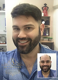 Valor de implante capilar em Sinop MT