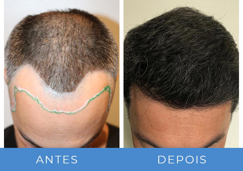 5 ideias de títulos:
1. Implante Capilar em Sinop: Guia Completo de Preços e Técnicas para 2026
2. FUE vs. FUT: Qual a Melhor Técnica de Transplante Capilar em Sinop?
3. Quanto Investir em um Transplante Capilar em Sinop? Fatores que Influenciam o Custo
4. Os Melhores Especialistas em Transplante Capilar em Sinop: Onde Encontrar?
5. Transplante Capilar Não é Coberto pelo SUS: Entenda as Opções em Sinop