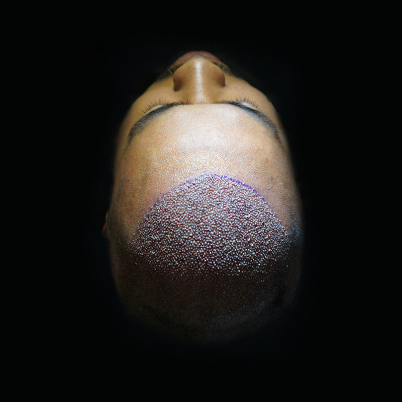 Valor por folículo transplante capilar 2026