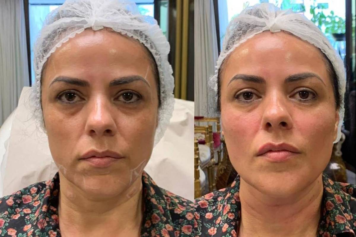 tratamento para flacidez