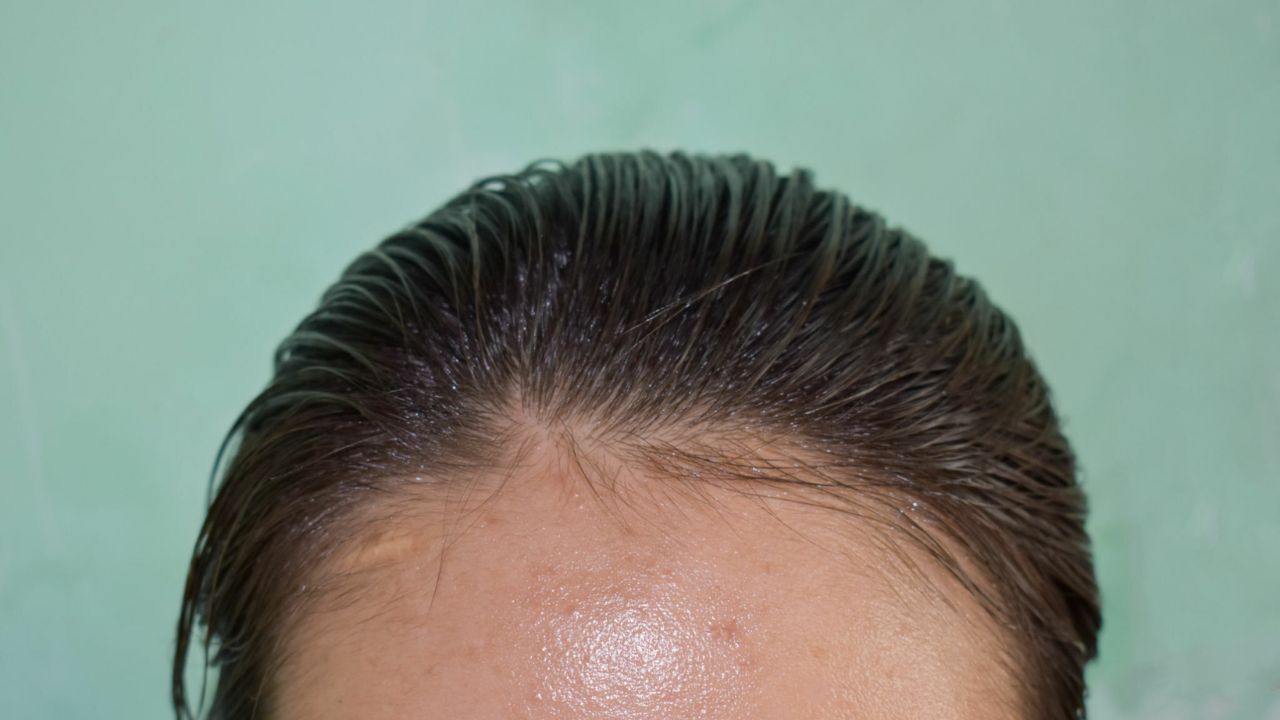 como tirar oleosidade do cabelo rapido