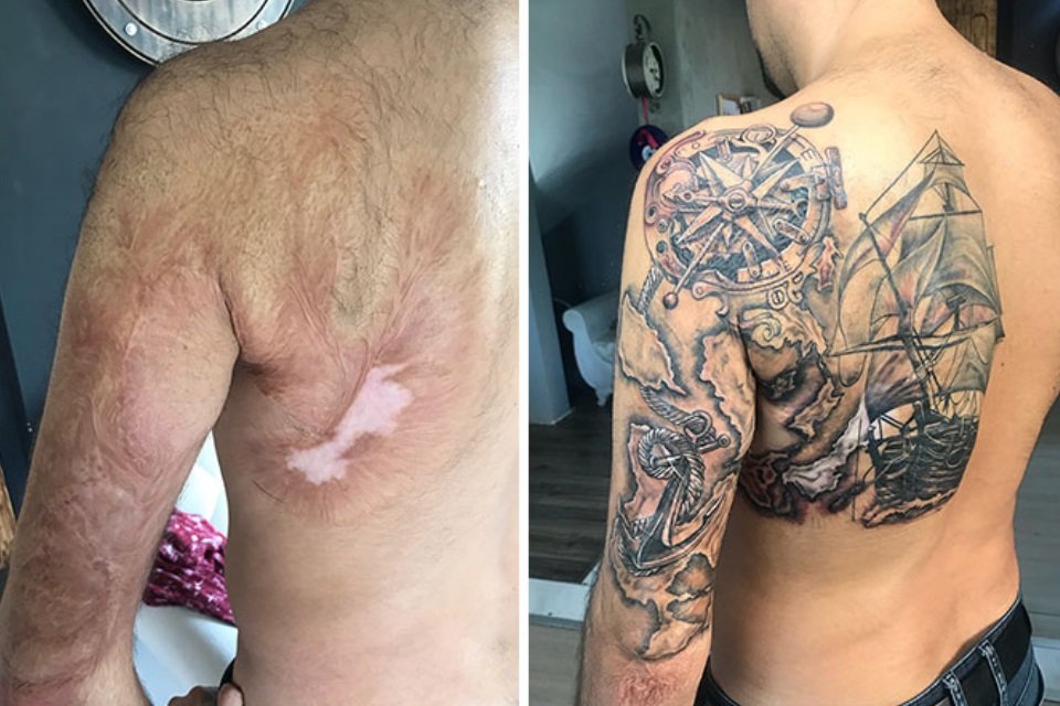 camuflagem de cicatriz de acne com tatuagem